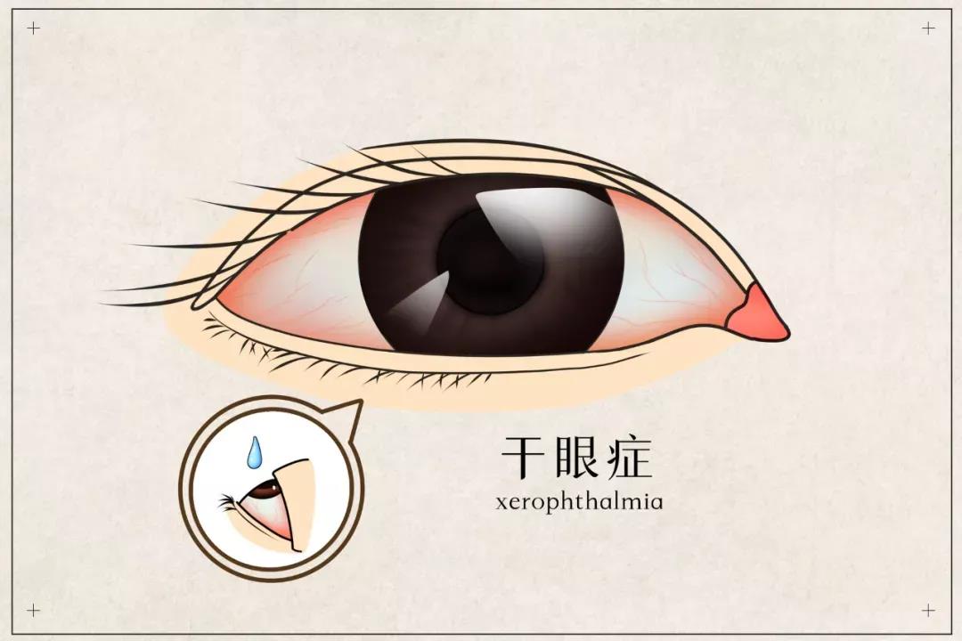干眼患者福音來(lái)啦！(圖2)